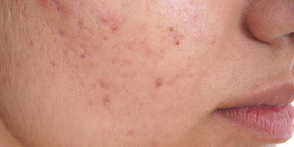 Image representing ACNE